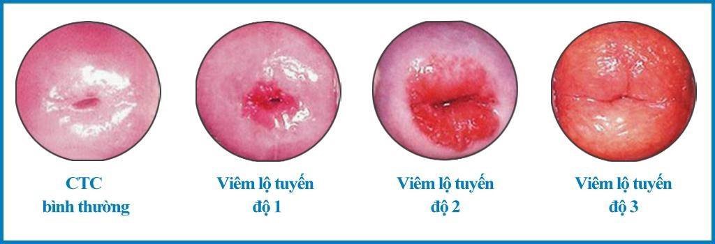 hình ảnh viêm lộ tuyến cổ tử cung